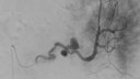 Viabahn Exclusion of Splenic Pseudoaneurysm